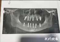 Chinês morre 13 dias após extrair 23 dentes e implantar 12 em uma única cirurgia